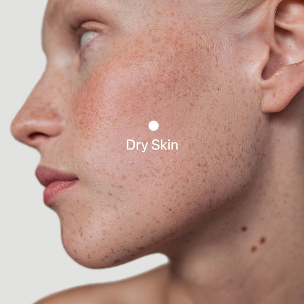 Dry Skin
