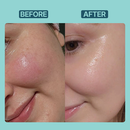Acne Control Serum 2% Salicylic Acid